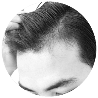 Hajhullás elleni és haj-újranövekedést serkentő komplex kezelés Férfiaknak